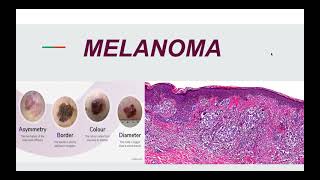 Malignant Melanoma Pathogenesis Morphology and Clinical picture [upl. by Dimo]