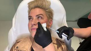 Female Facial Sculpting  Restylane Lyft to the Jawline Cheeks amp Undereye  West Hollywood CA [upl. by Newfeld]