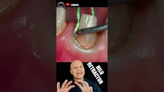 🔴Colocando HILOS en la ENCIA luego del TALLADO dental [upl. by Danuloff]