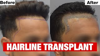 Natural Looking Hairline Transplant at Cara using Sapphire FUE Method [upl. by Arrehs977]