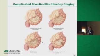 Diverticulitis To Operate or Not [upl. by Kcirederf499]