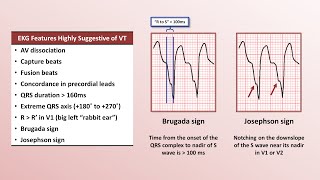 Advanced EKGs  Distinguishing VT from SVT with aberrancy [upl. by Inneg]