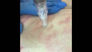 Skinpen Microneedling Procedure To Treat Stretch Marks [upl. by Clementi]