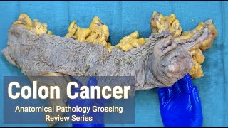 Colon Cancer  Anatomical Pathology Grossing Review Series [upl. by Ydnew]