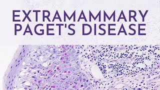 Extramammary Pagets Disease  Pathology mini tutorial [upl. by Janaya730]