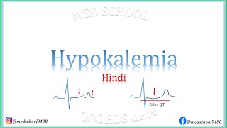 Hypokalemia Hindi [upl. by Lanta]