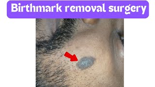 14824 Birthmark removal surgery Birthmark removal surgery in Ranchi  Mole removal surgery mole [upl. by Drogin697]