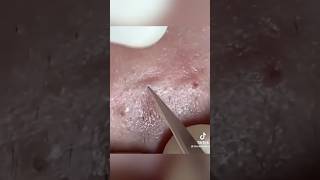 Élimination de Points Noirs Expressblackheads pimple acne [upl. by Devaney]