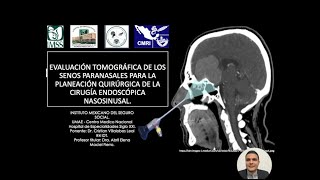 215 Evaluación Tomografía de las variantes anatómicas de los SPN  Dr Villalobos [upl. by Foy953]