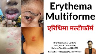 Erythema Multiforme EM  Round Target Rashes on skin  एरिथिमा मल्टीफॉर्म  Dr Uttam kumar Lenka [upl. by Giddings]