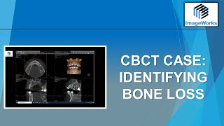 CBCT Case Identifying bone loss [upl. by Yahsram]