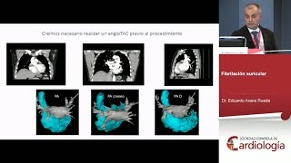 Casos difíciles en electrofisiología y ablación I [upl. by Nahsaj]