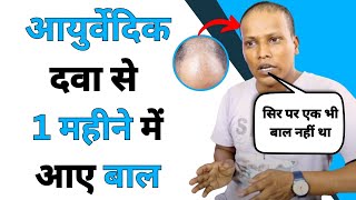 Alopecia Universalis 30 Cured in 1 Month  Patient Success Story B K Bhagat from Bihar [upl. by Annairdna253]