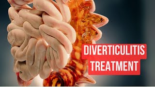 How To Treat Diverticulitis in 2024 [upl. by Obau]