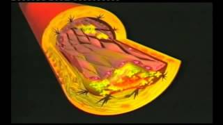 Dr Matthias Rath Instructional Video Cardiovascular disease Captions corrected till 4 min [upl. by Rolyt]