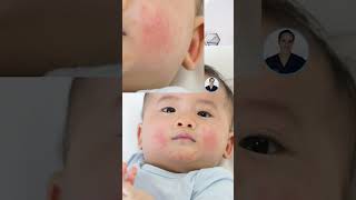 5 Common Baby Rashes shorts [upl. by Eanad572]