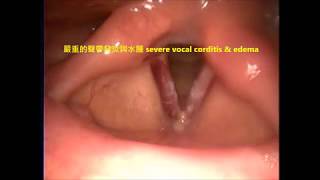 聲帶發炎 聲音沙啞 vocal corditis amp edema Dr KenLiao Liu [upl. by Riley776]