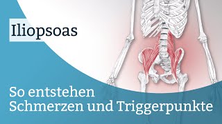 Iliopsoas Schmerzen Triggerpunkte und deren Aktivierung [upl. by Adnotal]