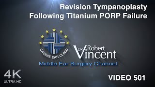 Revision Tympanoplasty Following Titanium PORP Failure [upl. by Loise]