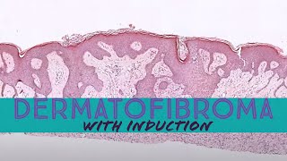 Dermatofibroma with induction phenomenon pathology dermpath dermatology dermatopathology [upl. by Marabel958]