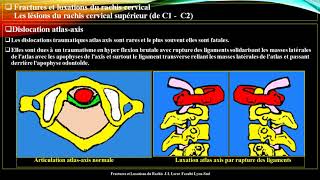 Pr Atia Traumatisme du rachis cervical 2 [upl. by Adihsar]