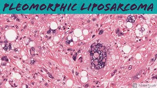 Pleomorphic Liposarcoma 5Minute Pathology Pearls [upl. by Caty]