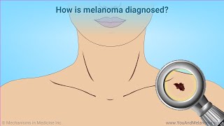 Diagnosing Melanoma [upl. by Hinda711]