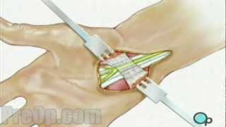 Carpal Tunnel Syndrome Repair Surgery  PreOp® Patient Education Medical HD [upl. by Elton]