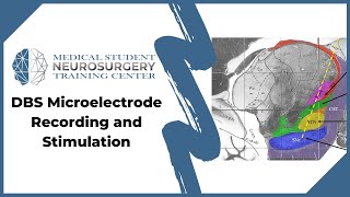 DBS Microelectrode Recording and Stimulation [upl. by Auqinat688]