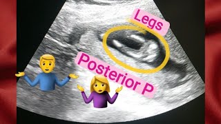 13 weeks oregnant gender reveal  posterior placenta means baby boygirl  how to tell gender on usg [upl. by Novyad528]