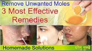 Remove mole on face At Home  Remove Moles Naturally Health Tips In English [upl. by Olia329]