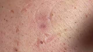 Acne Treatment Huong Da Nang  2024 blackheads 703 [upl. by Gilemette956]