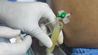 Remove abdominal fluid ascites  Paracentesis  Ascitic fluid aspiration [upl. by Bibeau]