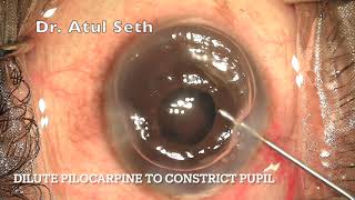 PHACO in rigid non dilating pupil with BHex Ring  DR ATUL SETH [upl. by Aissyla]