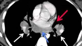 LearningRadiology 55 Sarcoidosis [upl. by Adnik97]