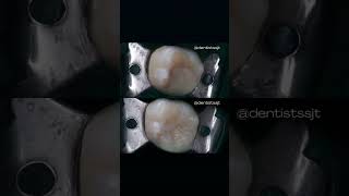 Incrustación dental odontologia ecuador shorts youtubeshorts [upl. by Loraine]