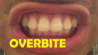 how to fix an overbite without braces [upl. by Nomannic317]