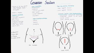 Cesarean Section  Types Indications Incisions etc [upl. by Cart]