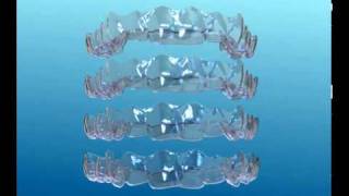 Centro Daina  Invisalign Ortodonzia Invisibile [upl. by Eneleahs]