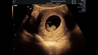 9 Weeks Ultrasound  8 weeks 4 days Technically [upl. by Rosenblast]