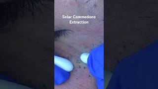 Solar Commedone extraction extraction blackheads acne satisfyingvideo [upl. by Luedtke473]