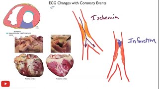 Myocardial ischemia amp infarction  STEMI NSTEMI Q wave infarction Wellens syndrome [upl. by Lrigybab715]