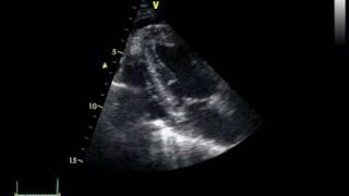 CHRONIC PERICARDITIS with thickening of the pericardium [upl. by Eillim764]