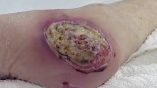 Wound Care Part 3 Types of Wounds [upl. by Sjoberg]