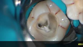 PASSIVE ultrasonic irrigation irrisafe during one visit endodontic treatment [upl. by Skyler]