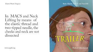 37 Basic Elastic MACS and Neck Lift without dissection of the cheeks and neck stepbystep [upl. by Whitson]