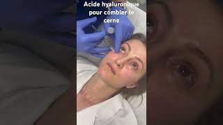 L’acide hyaluronique pour effacer les cernes creux  Dr Raspaldo cernes medecineesthetique [upl. by Terag267]