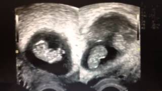 Triplets baby ultrasound at 9 weeks [upl. by Anahsar]