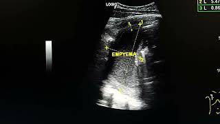 Chest ultrasound shows empyema in a female Hx renal failure [upl. by Susanna]