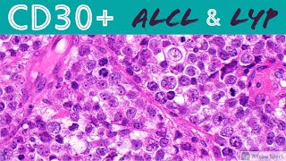 Anaplastic Large Cell Lymphoma amp Lymphomatoid Papulosis CD30 Positive Lymphoproliferative Disorders [upl. by Dania392]